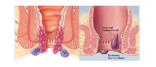 Obat ambeien luar tanpa operasi, obat untuk penyakit ambeien salep, obat buat penyakit ambeien berdarah ibu hamil, obat untuk mengobati wasir ambeyen herbal, cara mengobati penyakit wasir/wasir secara alami, obat wasir atau ambeien utk wanita hamil, mengatasi wasir anak, cara menghilangkan luka ambeien atau wasir, obat untuk mengobati wasir hpa, obat untuk penyakit wasir di suwawa, obat penyakit ambeien oles untuk ibu hamil